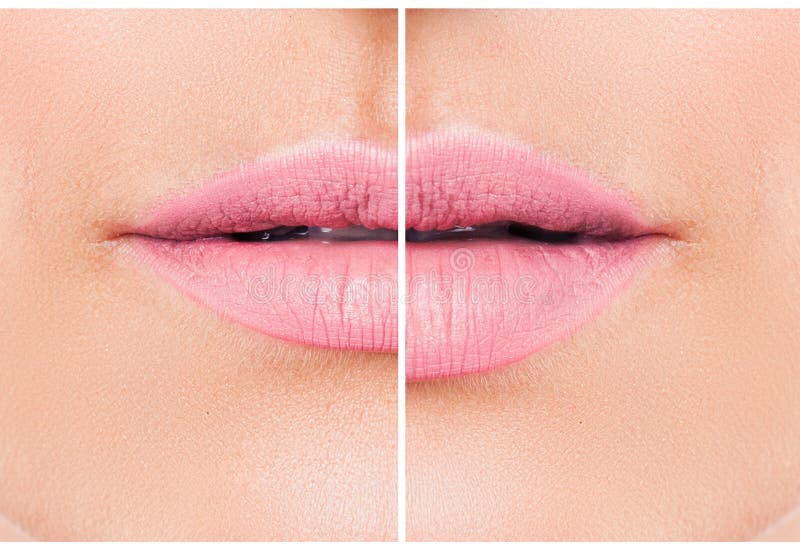 Woman lips before and after lip filler injections.