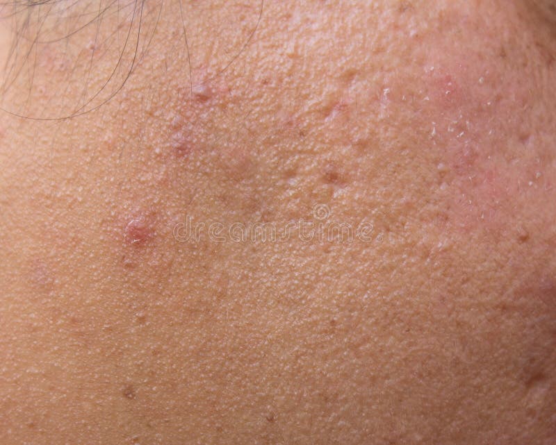 Woman with oily skin and acne scars royalty free stock images Woman with oily skin and acne scars royalty free stock images