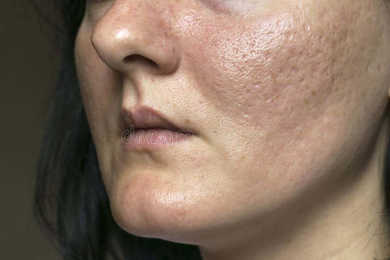 white acne scars on face