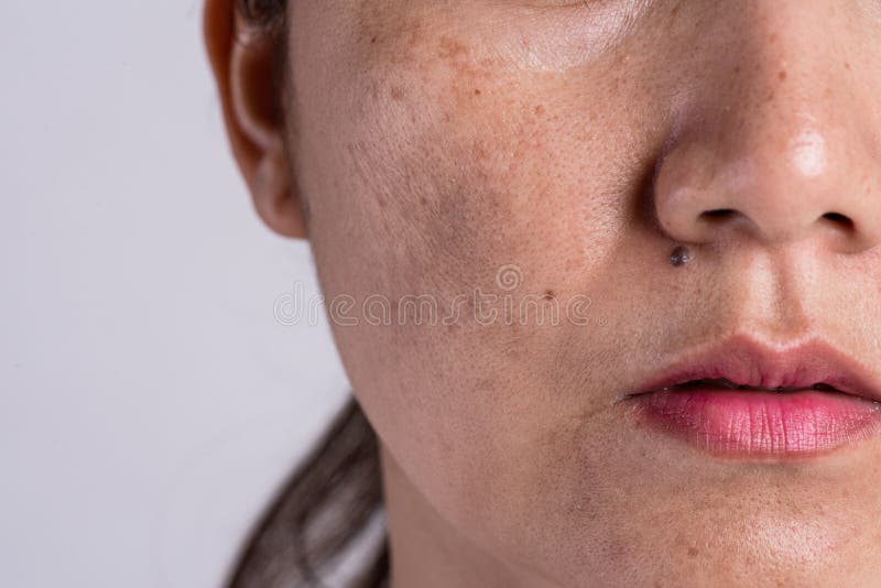 Žena problematický kůže a akné jizvy.