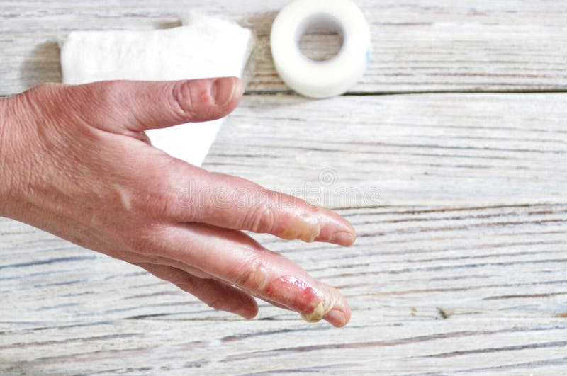 Woman with a Burn of the Skin and Fingers, Injuries with Boiling Water
