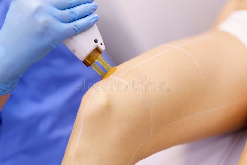 Woman receiving legs laser hair removal at a beauty center.