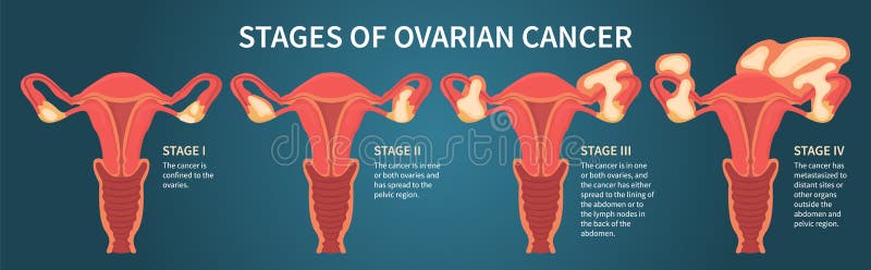 Cancer Ovarian Stock Illustrations – 839 Cancer Ovarian Stock ...