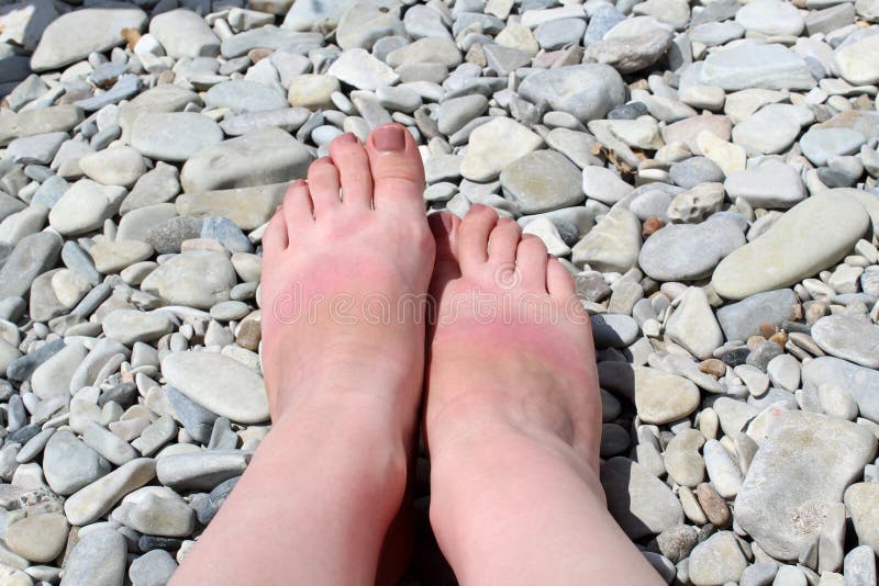 A Woman`s Leg Stands On A Pebble Beach Red Tanned Feet Sunburn Stock
