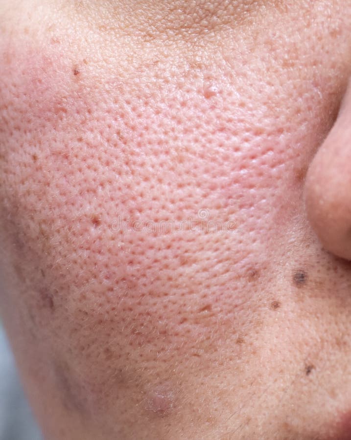 white acne scars on face