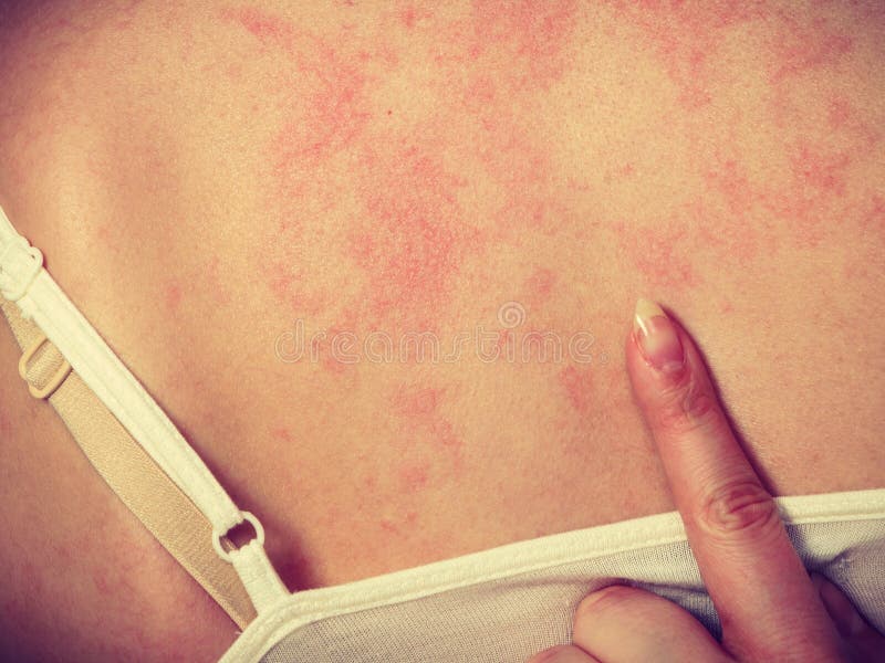 Health problem, skin diseases. Young woman showing her itchy back with allergy  rash urticaria symptoms Stock Photo - Alamy