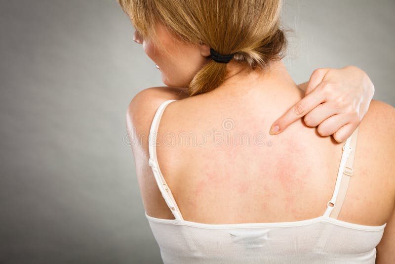 Health problem, skin diseases. Young woman showing her itchy back with allergy  rash urticaria symptoms Stock Photo - Alamy