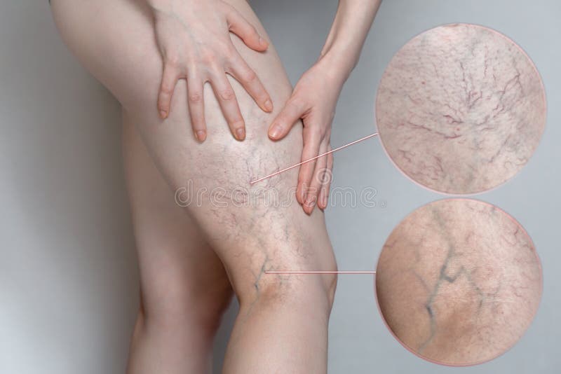 3,608 Varicose Veins Stock Photos - Free & Royalty-Free Stock