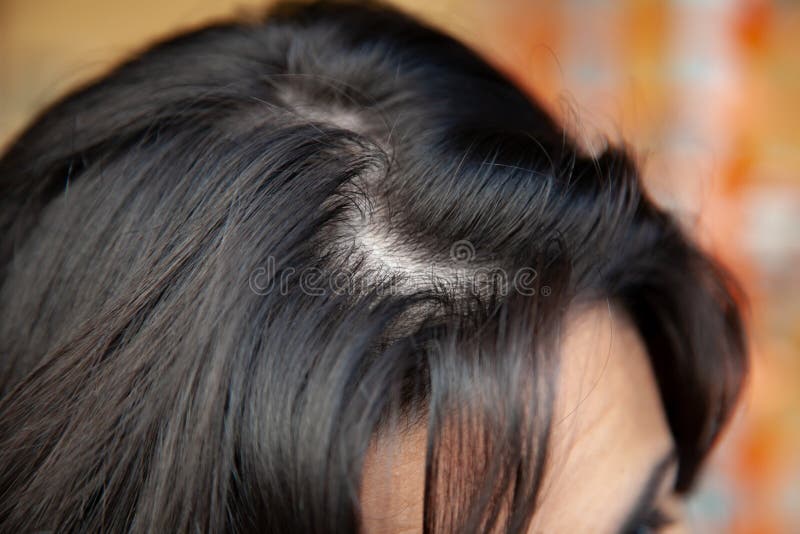 Woman Shows Thinning Hair Near the Root with Oily Hair Problems Stock Image - Image of growth, greasy: 197888161 Woman Shows Thinning Hair Near the Root with Oily Hair Problems Stock Image - Image of growth, greasy: 197888161