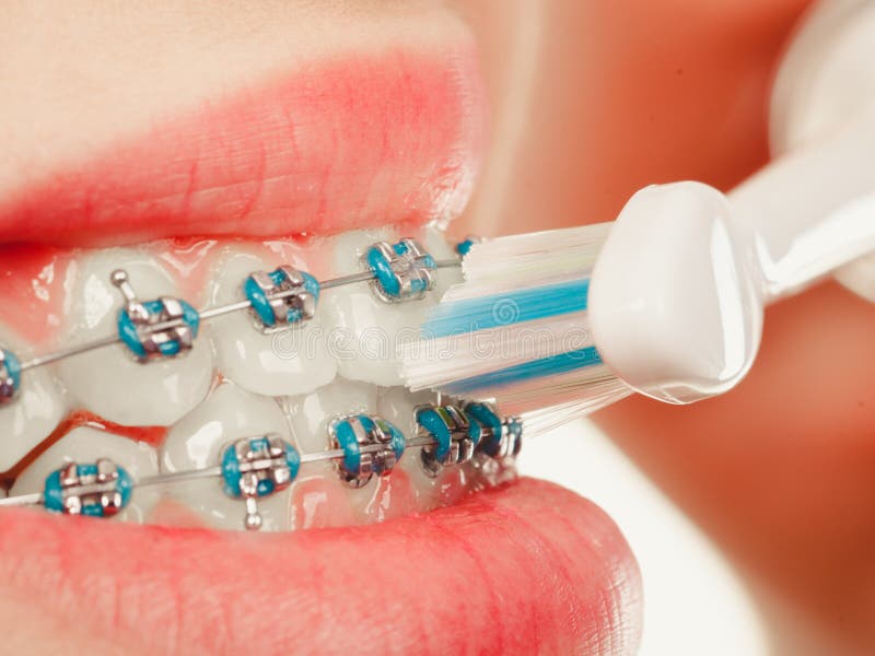 Woman Smiling Cleaning Teeth with Braces Stock Image - Image of braces ...