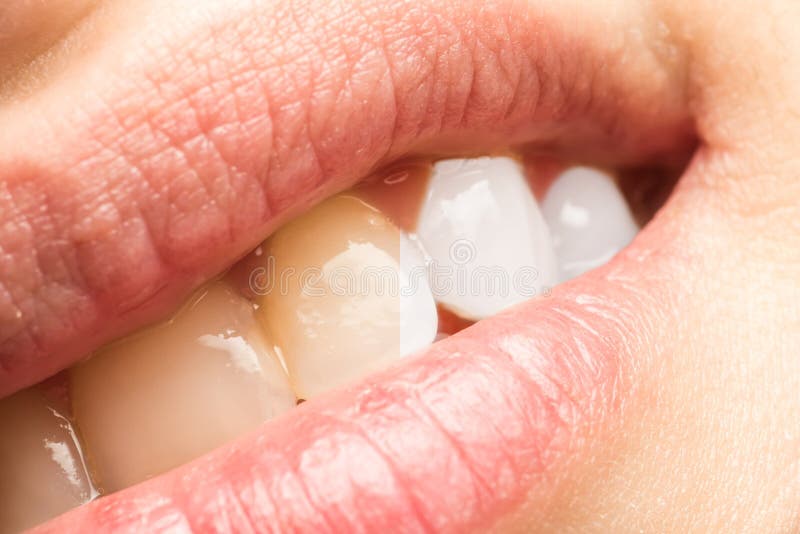 Woman Teeth before and after Dentist Whitening Procedure Stock Image