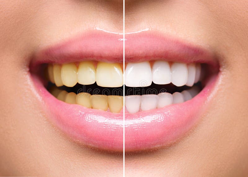 Woman teeth before and after whitening. Oral care