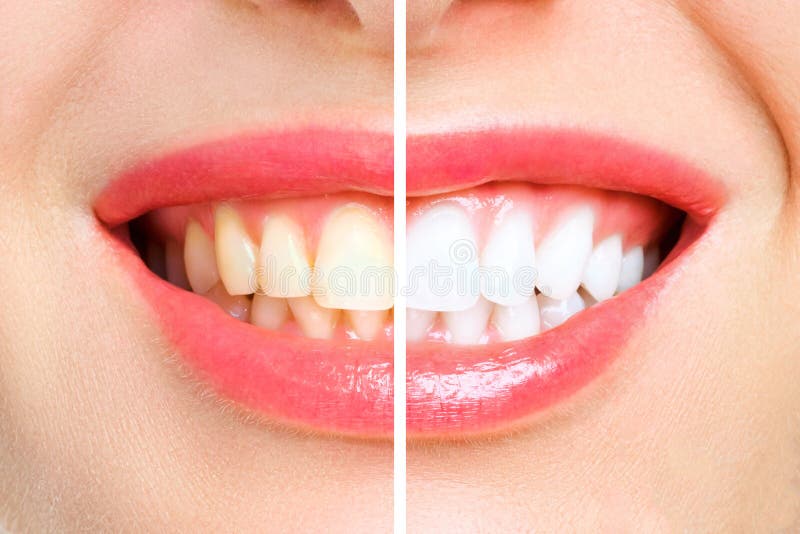 Woman teeth before and after whitening. Over white background.