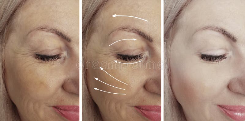 Woman wrinkles face rejuvenation before and after correction treatment collage royalty free stock image Woman wrinkles face rejuvenation before and after correction treatment collage royalty free stock image
