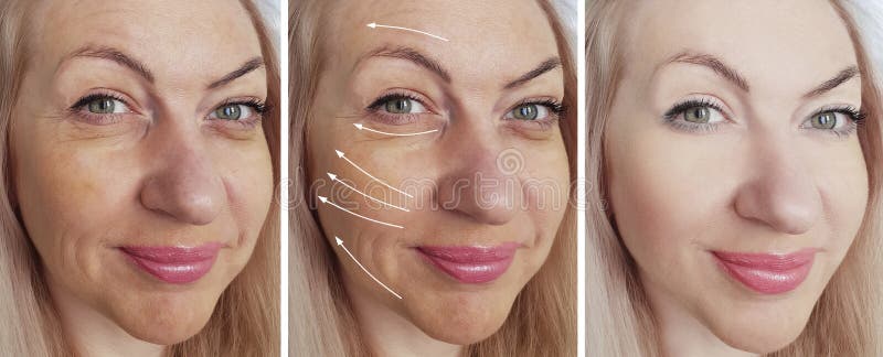 Woman wrinkles face rejuvenation difference before and after correction treatment collage royalty free stock photography Woman wrinkles face rejuvenation difference before and after correction treatment collage royalty free stock photography