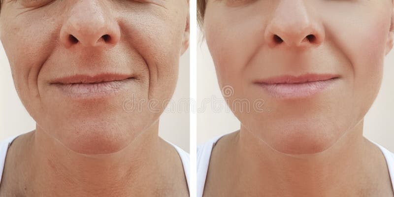 Woman wrinkles face before and after cosmetic procedures filler treatment. Woman wrinkles face before and after cosmetic procedures filler treatment