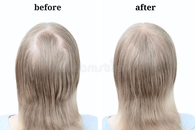 Women blond hair after using cosmetic powder to thicken hair. Before and after