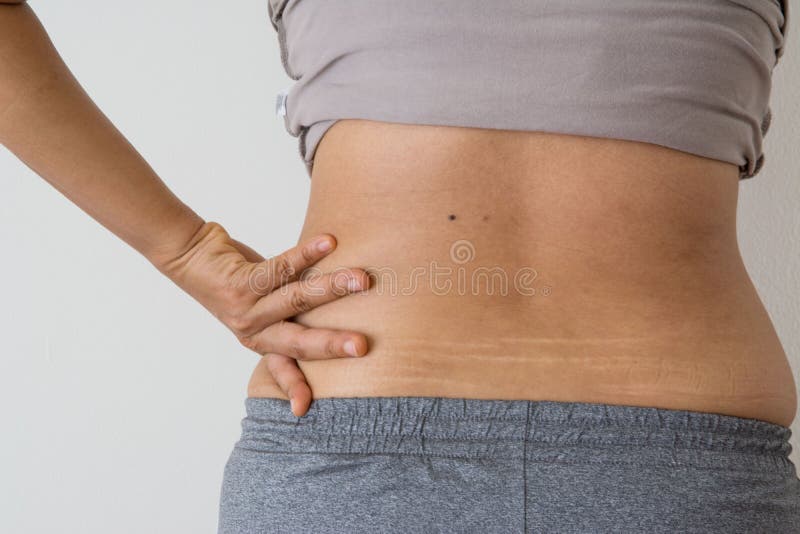 Can you get rid of stretch marks on the back? Causes and treatment