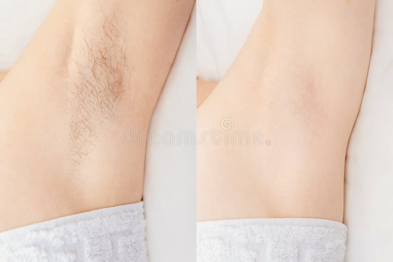 Women Underarm Hair Removal. Concept Before And After