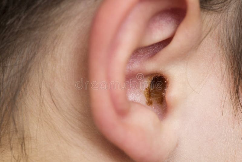 Earwax in the dirty ear of a child. Hole ear of human, wax on hair and skin of ear. Earwax in the dirty ear of a child. Hole ear of human, wax on hair and skin of ear.