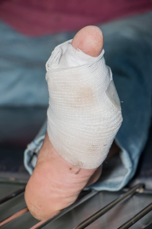 Wound of diabetic foot stock photo. Image of infection 55108510