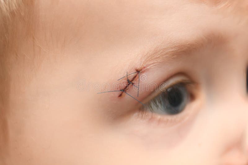 Boy With Sutures On Eyebrow Stock Photo - Image of brow, white: 7435420