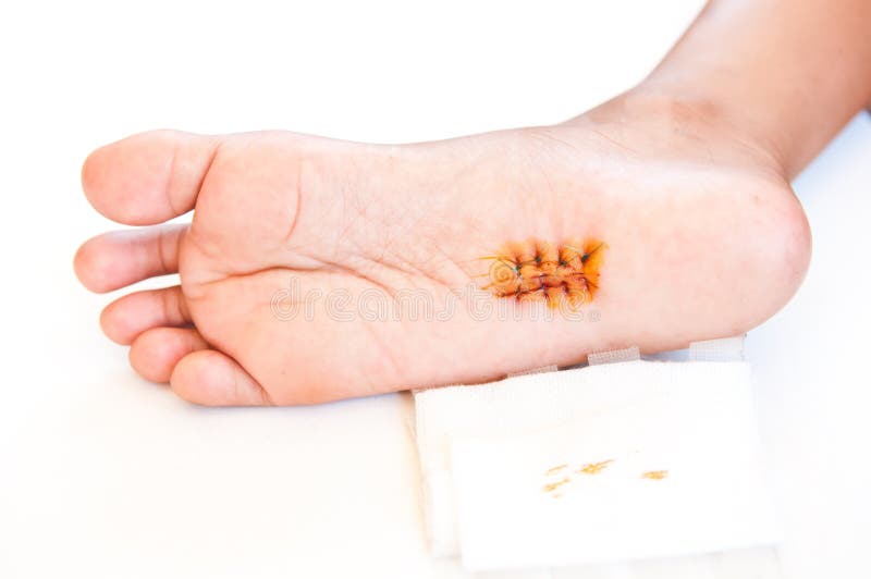 Wound on the feet stock photo. Image of surgery, seam 24946878