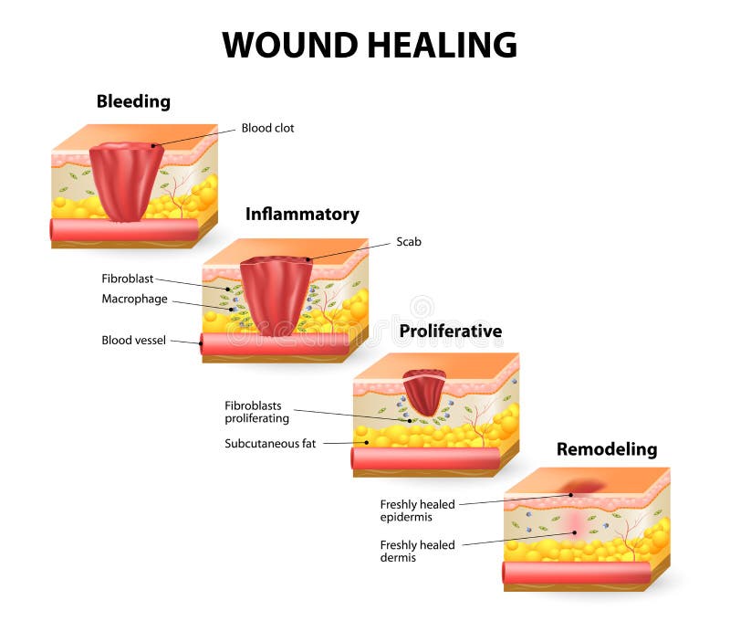 Wound Stock Illustrations – 18,234 Wound Stock Illustrations, Vectors &  Clipart - Dreamstime