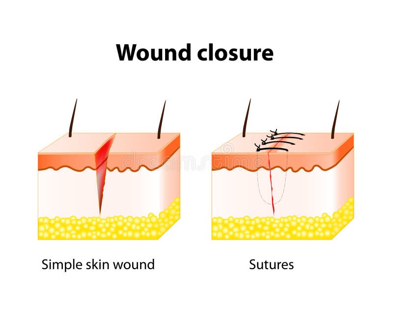 Wound Stock Illustrations – 18,234 Wound Stock Illustrations, Vectors &  Clipart - Dreamstime