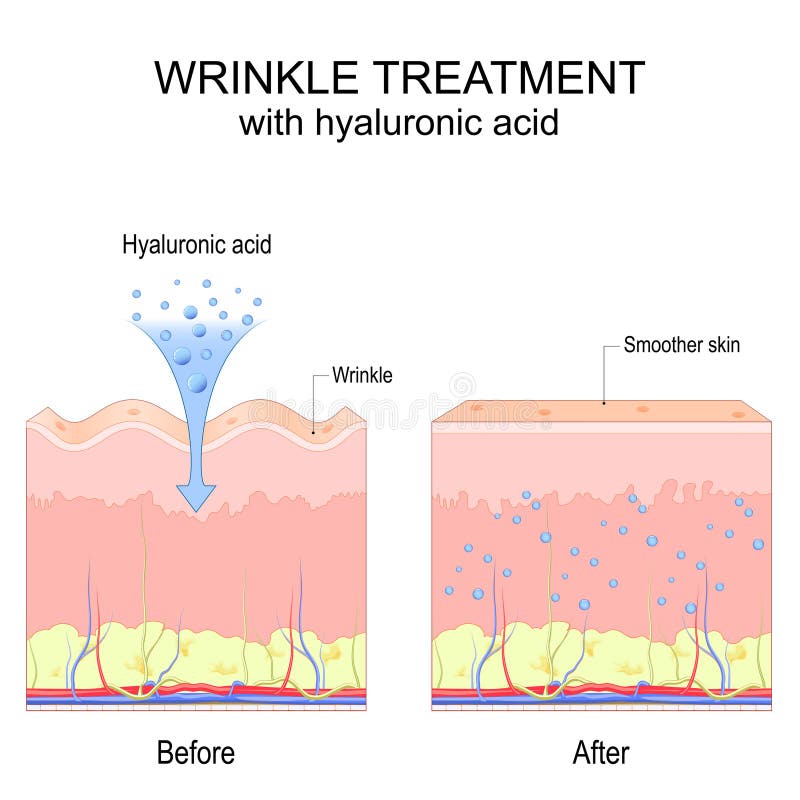 Wrinkle treatment with hyaluronic acid