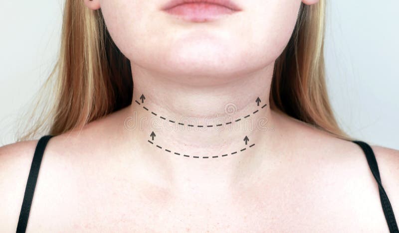 A cosmetologist prepares the patient for surgery: contour plastics of the neck, mesotherapy or botulinum therapy. Wrinkles and royalty free stock photography A cosmetologist prepares the patient for surgery: contour plastics of the neck, mesotherapy or botulinum therapy. Wrinkles and royalty free stock photography