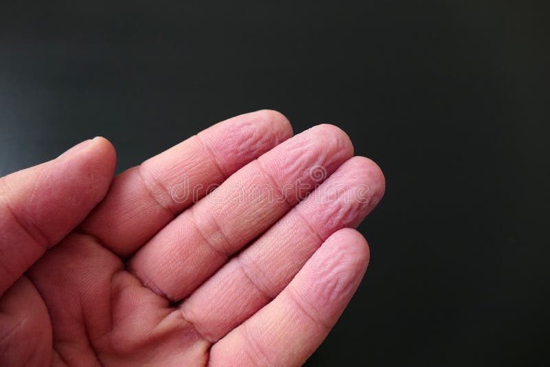 Wrinkles Of Fingers Left In The Water, Wrinkled Fingertips Due To Water Stock Photo - Image of disease, concept: 176042694