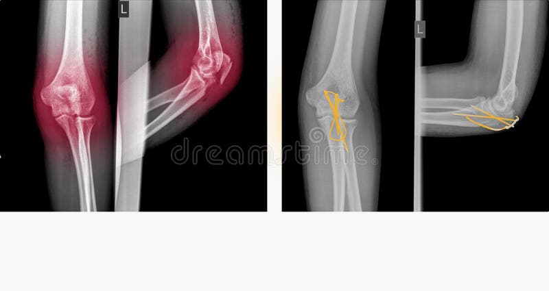 膜肘骨折内上髁肱骨及内固定支柱库存图片 图片包括有经纪 医疗 诊断 医院 考试 健康