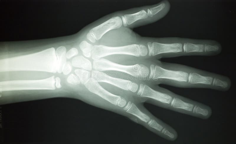 An x-ray pic of an hand with fingers. An x-ray pic of an hand with fingers