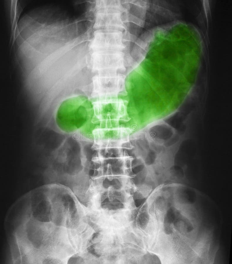 X-ray image of abdomen supine position, show gastric juice. X-ray image of abdomen supine position, show gastric juice.