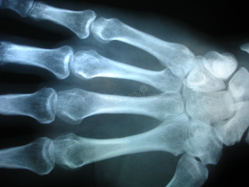 Download X-ray stock photo. Image of skeletal, thumb, nurse, break - 159552