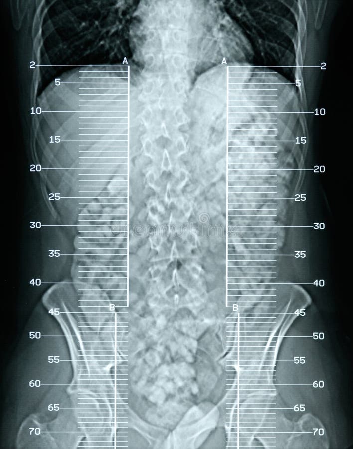 X-Ray