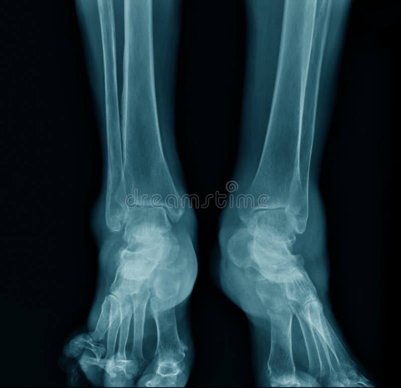 X-ray ankle AP view royalty free stock images X-ray ankle AP view royalty free stock images
