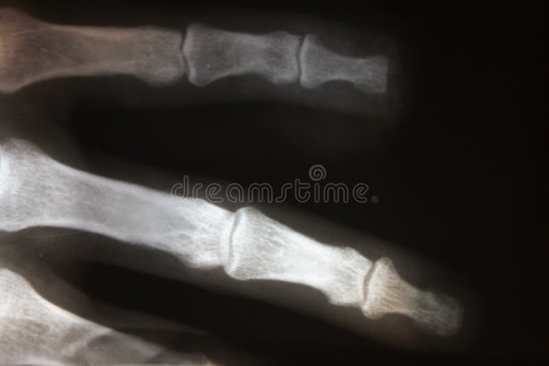 x-ray beeld van menselijke lichaamsdelen, x-ray beeld stock foto x-ray beeld van menselijke lichaamsdelen, x-ray beeld stock foto