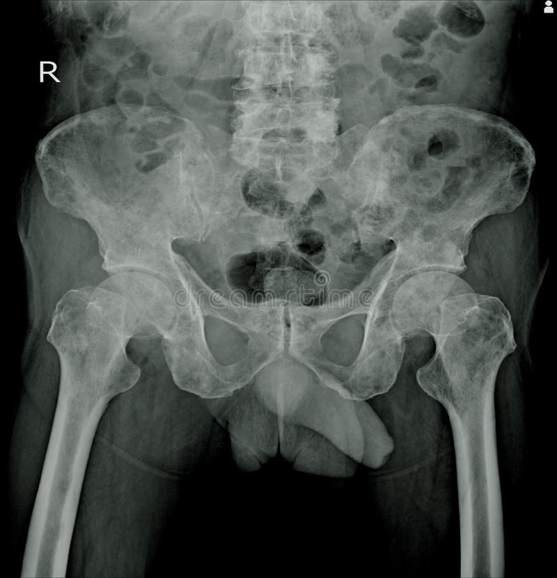 X Ray Both Hip Impression Multiple Bone Metastasis Stock Photo Image Of Multiple Human 156553514