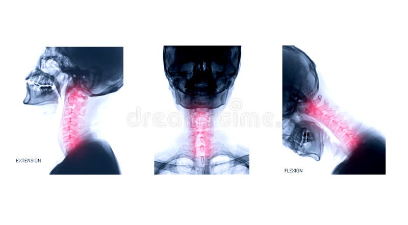 X-ray C-spine or x-ray image of Cervical spine Lateral extension ,AP and Flexion view for diagnostic intervertebral disc herniation