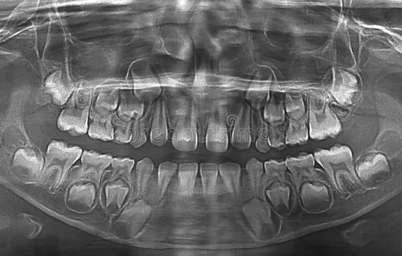 X ray of child teeth stock photo. Image of dentistry 76618006