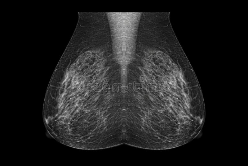 breast cancer digital mammogram