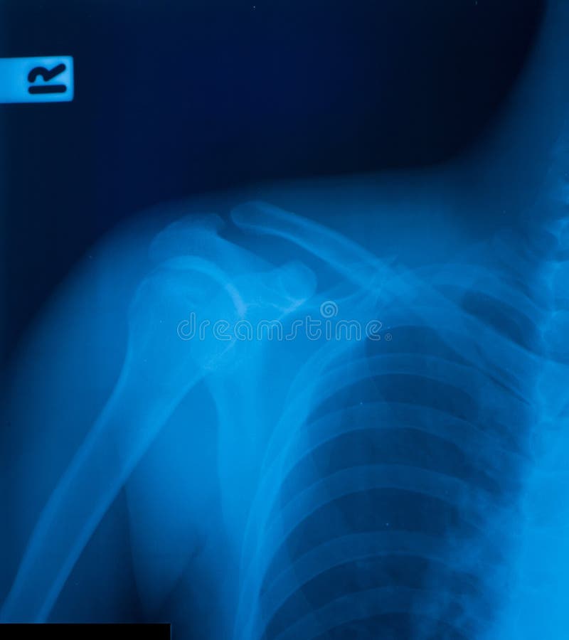 Xray film of shoulder stock photo. Image of clinic, film 1221596