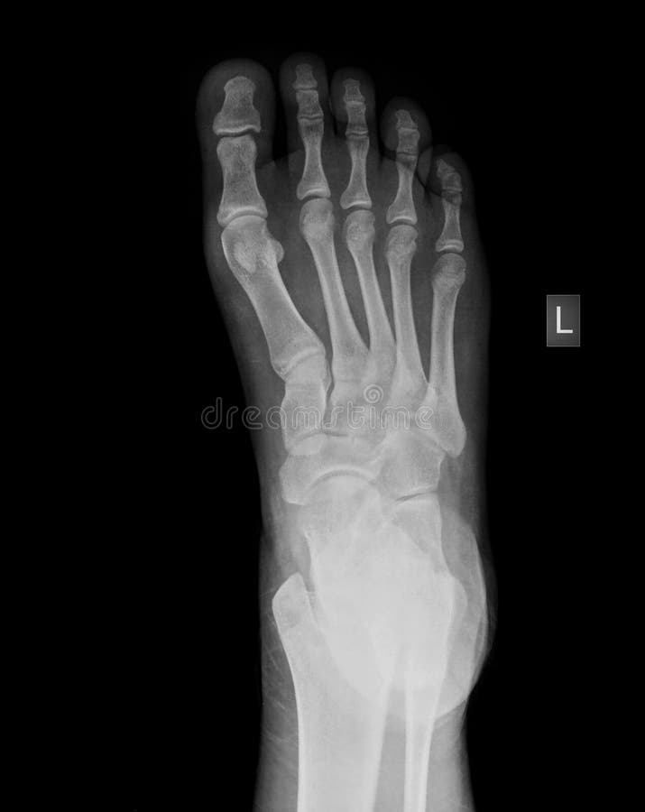 Xray of foot stock photo. Image of bone, human, medicine 47700848