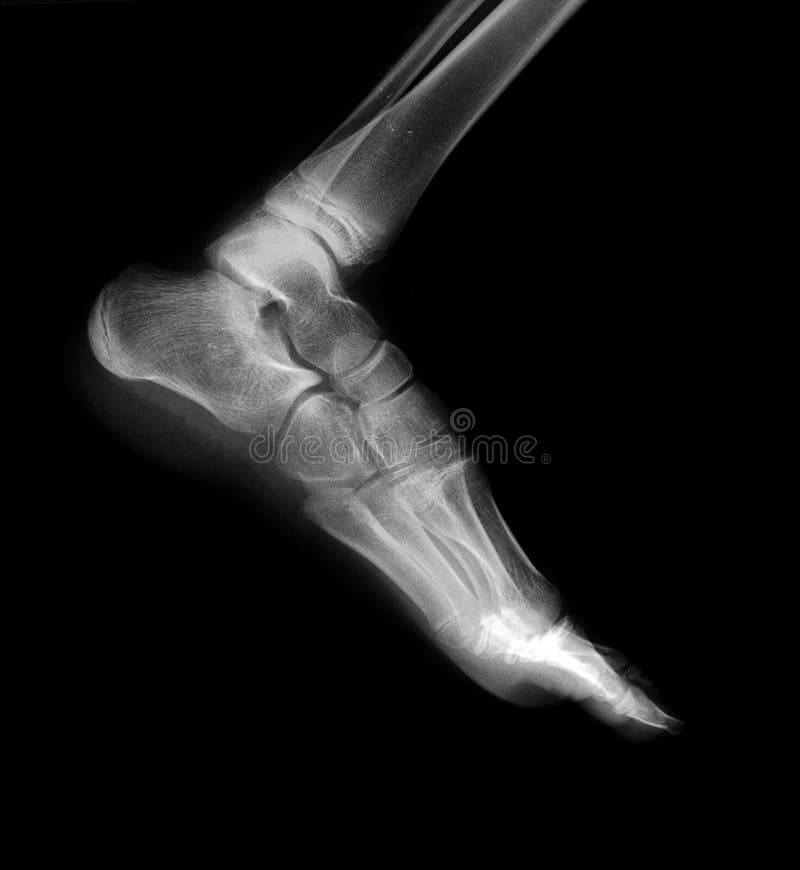 Xray of foot stock photo. Image of radiation, film, clinic 43859408