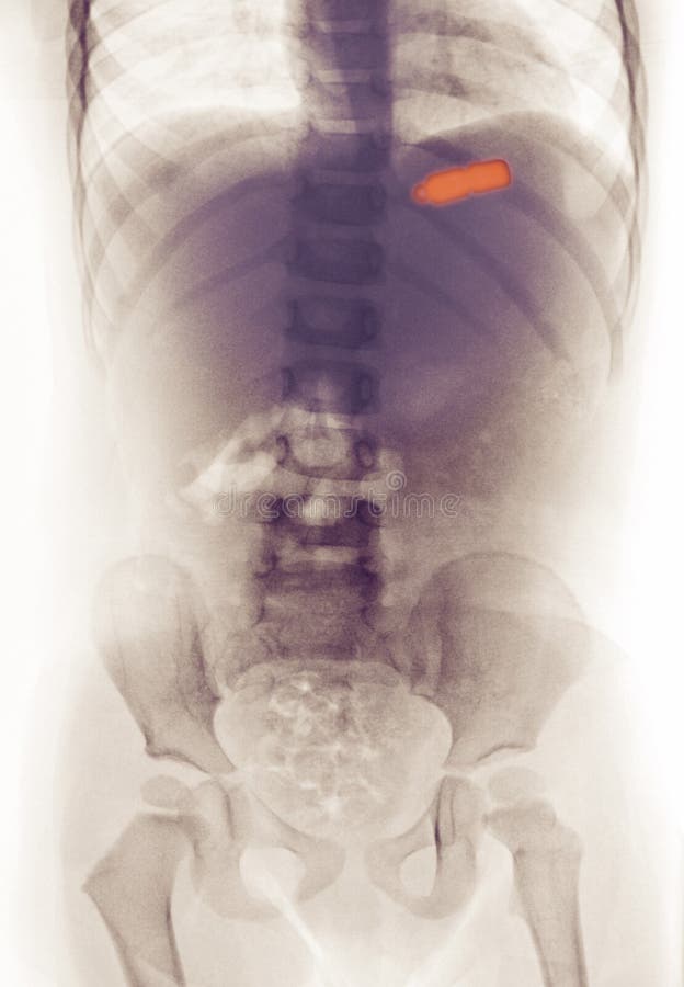 X-ray of a girl who swallowed a toy