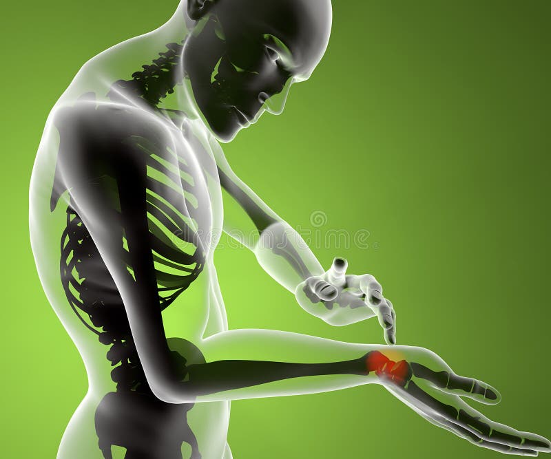 Xray hand arm wrist pain stock illustration. Illustration of rupture