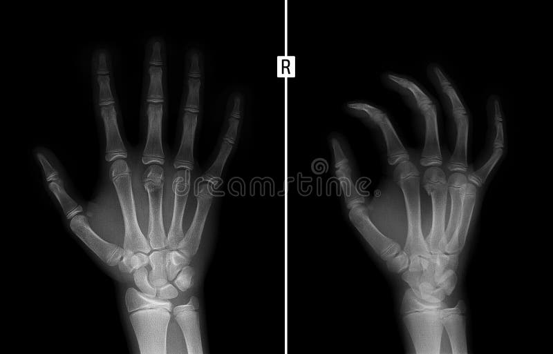 X-ray of the hand. Fracture of the 3rd metacarpal bone the child. stock photos X-ray of the hand. Fracture of the 3rd metacarpal bone the child. stock photos