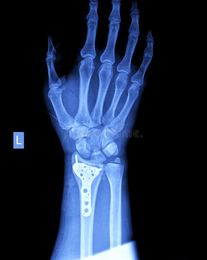 Xray of hand stock photo. Image of medicine, imaging 47703018
